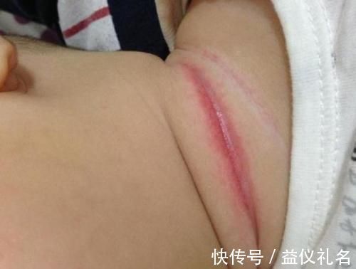 褶皱处|三个月的宝宝“淹脖子”,原来是它们惹的祸,宝妈们可别再用了