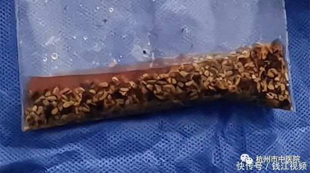 疯狂|从“疯狂的石头”到一口袋碎石子再到脓毒血症,这都经历了什么啊