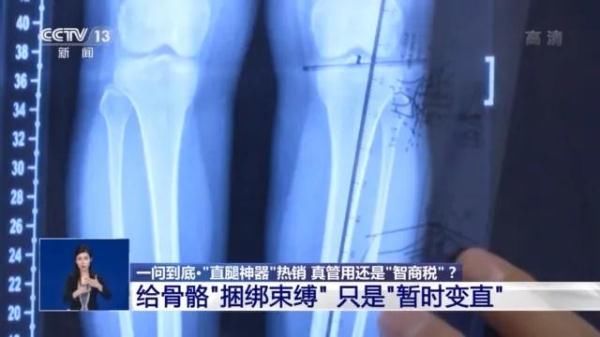 o型腿|什么是“直腿神器”？真的能让腿又长又直吗？