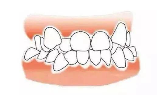 正畸科|牙齿三个 “关键期” ,千万别错过!否则毁掉孩子一口好牙