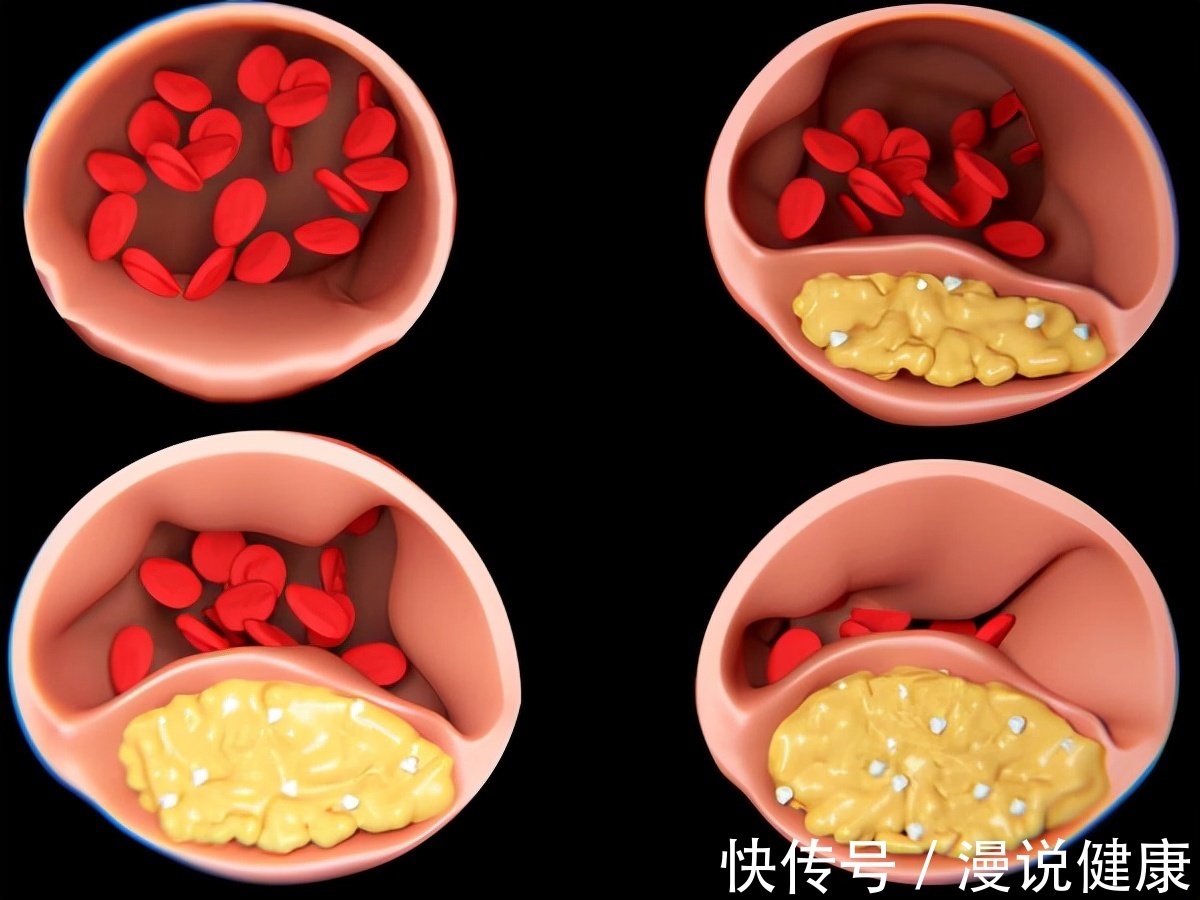 低脂肪|三餐点外卖，男子差点丢了性命？好端端的，咋就突发凶险性心梗？