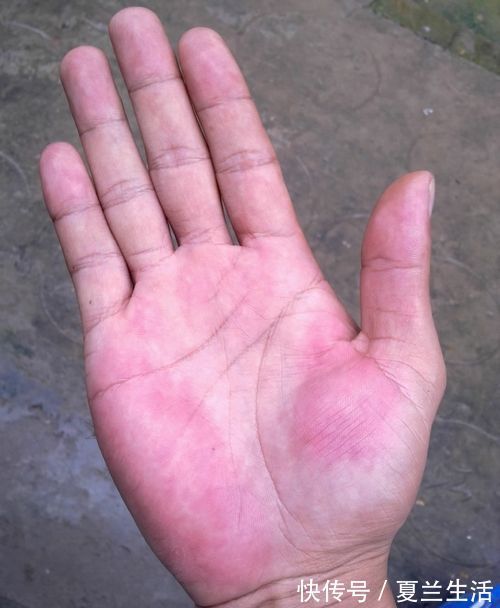 肝掌|肝好不好,全“写”在手上,手上若无3种“表现”,肝脏很健康