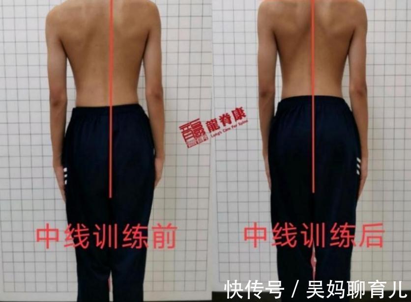 小陈|孩子出现高低肩、身体偏歪?小心这可能是脊柱侧弯惹的祸