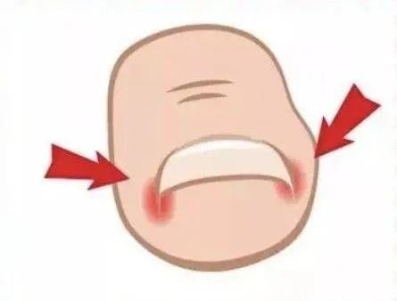 指甲缝|指甲剪不对带来大麻烦,这才是剪指甲的正确方法!