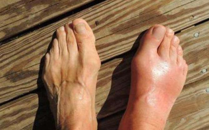 肉食|痛风患者一点肉食不能碰？营养师：只是自己没吃对，注意5点即可