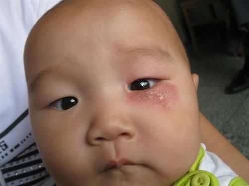 妈妈|两个月婴儿全身溃烂有脓,妈妈称家里不关窗,被“毒虫”趁虚而入