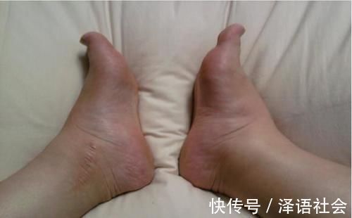 积液|为何怀孕后脚会变大?生完娃后还能恢复如初吗?