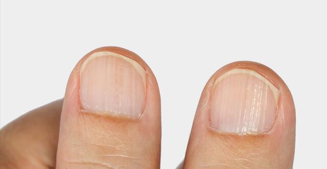 肝脏疾病|肝不好的人,上半身藏不住,出现这4种标志,尽快检查肝功能