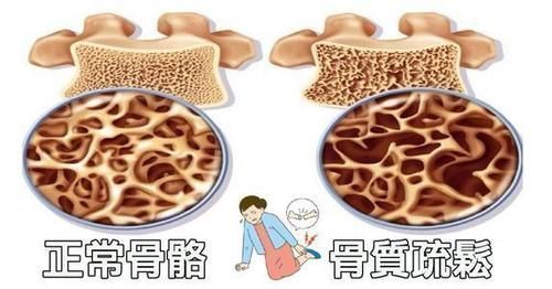 钙质|燕麦是骨质疏松的“发物”?专家:想骨骼强壮,“3种”食物少吃