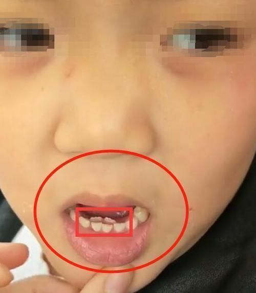 8岁男童长出“双排牙”,被拔掉时疼哭了,得知原因后奶奶崩溃