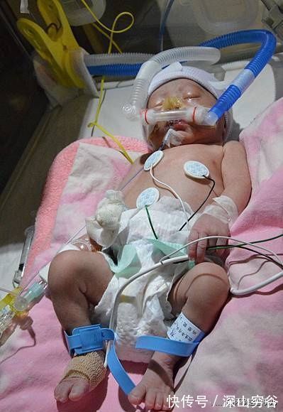 软便剂|终于卸货啦!让我不敢再回想的双胞胎待产和生产记录,住进ICU