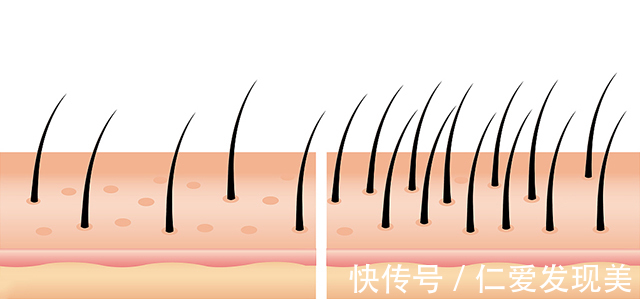头发|植发效果到底是由什么来判断？