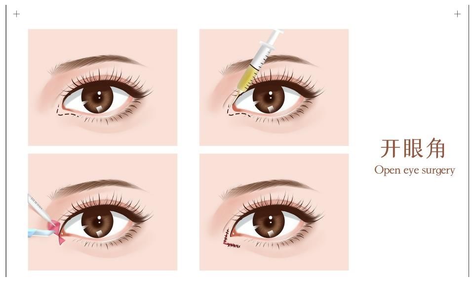 做了开眼角手术留疤，开眼角留疤该怎么祛除