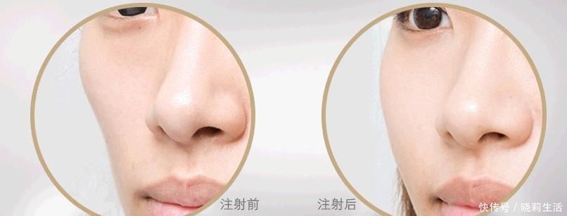 护理|面部脂肪填充能维持多久术后护理很重要