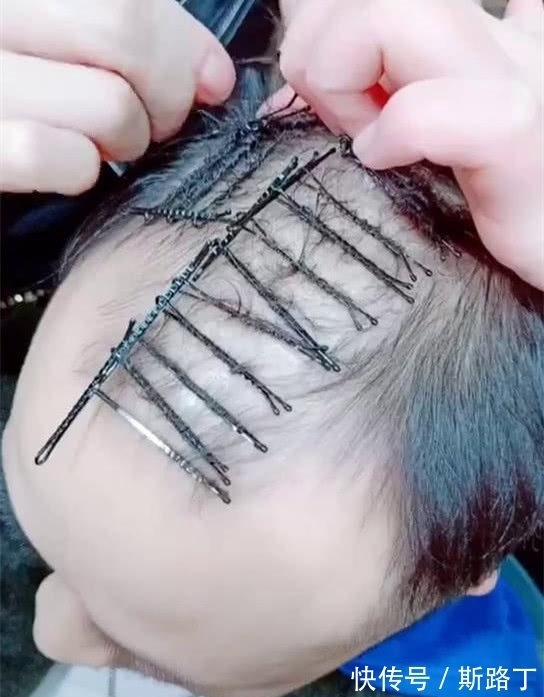 男子|奇闻:男子用黑色发卡烫发,卷起来头发更稀疏,怕剩下头发被扯掉