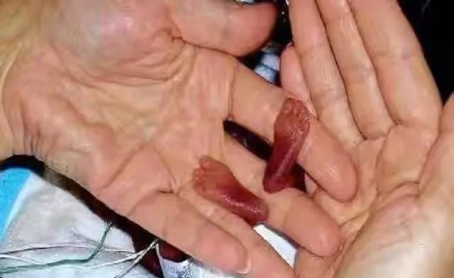 天不遂人愿|还记得14年前那个拇指姑娘吗出生只有24厘米,现状让人欣慰