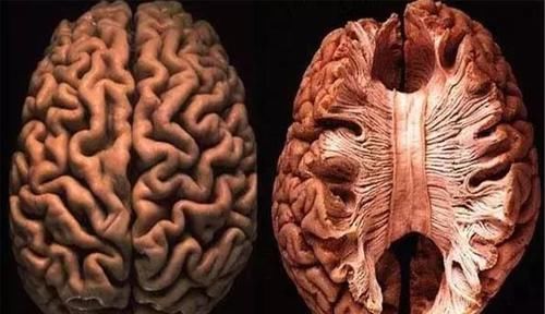癫痫病|“裂脑人”拥有过人智慧,被认为拥有超能力,其实他们极为痛苦!
