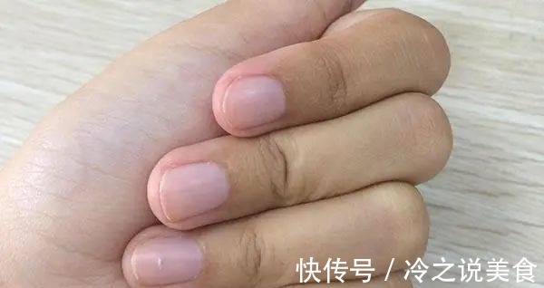 肺癌|夫妻俩先后查出肺癌,医生手部早就给出提醒,却没及时发觉