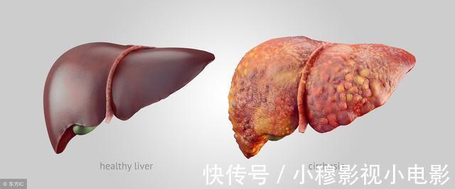 掌心|肝癌多是“拖”出来的,如果双脚有4种迹象,趁早就医,能保命!