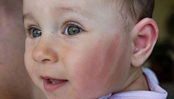 宝宝|孩子脸上的“高原红”是冷空气过敏吗?