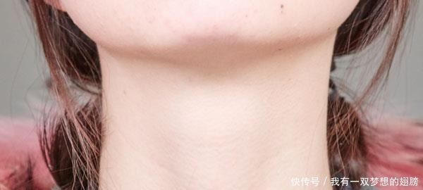 患有甲状腺结节怎么办平时少吃这3种食物，或能缓解病情！