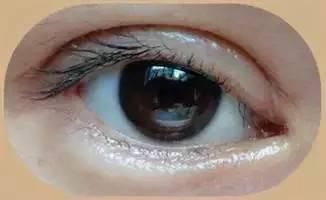 化妆品|割双眼皮疤痕增生怎么办 不想留疤一定要看!