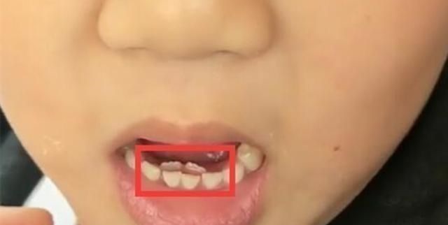 乳牙|6岁男孩长出“双排牙”,要一颗颗拔掉,妈妈自责不已,都怪我