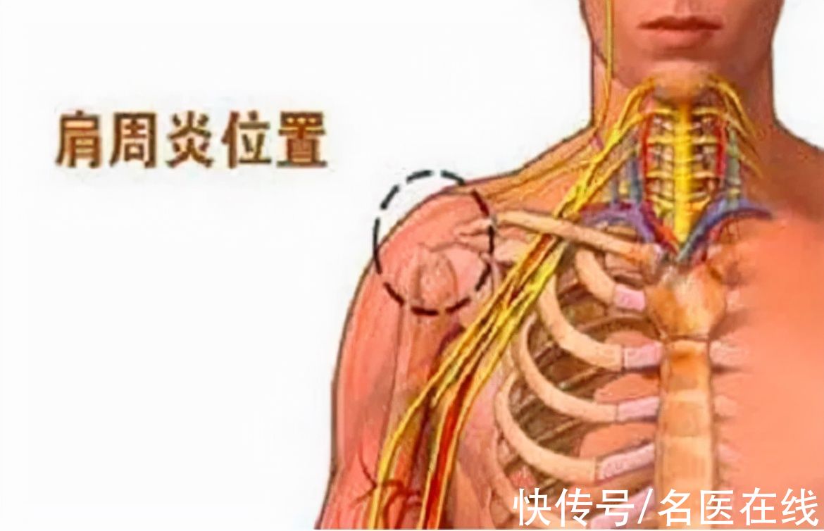 肩周炎|肩周炎到底是怎么回事？三分钟解析清楚