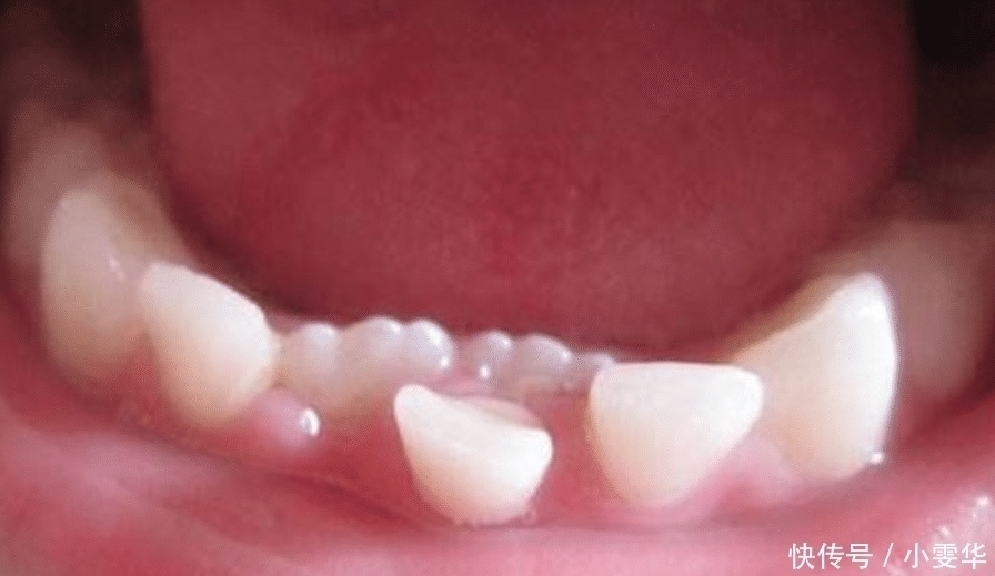 乳牙|孩子七岁时候的乳牙,家长们不要乱丢,关键时刻能救孩子一命