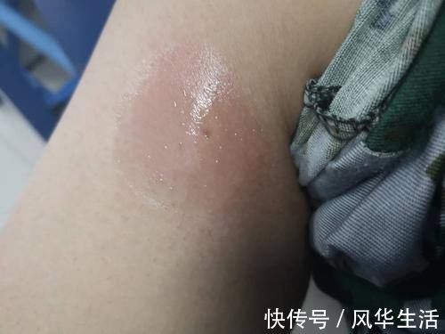 蜂毒能以毒攻毒|蜂毒能以毒攻毒,消灭癌细胞?最新研究结果,告诉你事实真相