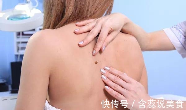 小痣|癌症来临时,皮肤会出现4个变化,希望你可以及时知晓