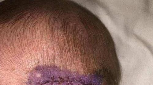 自愈能力|剖腹产划伤孩子头部,医生很快就会好的,7年后家长找上医院