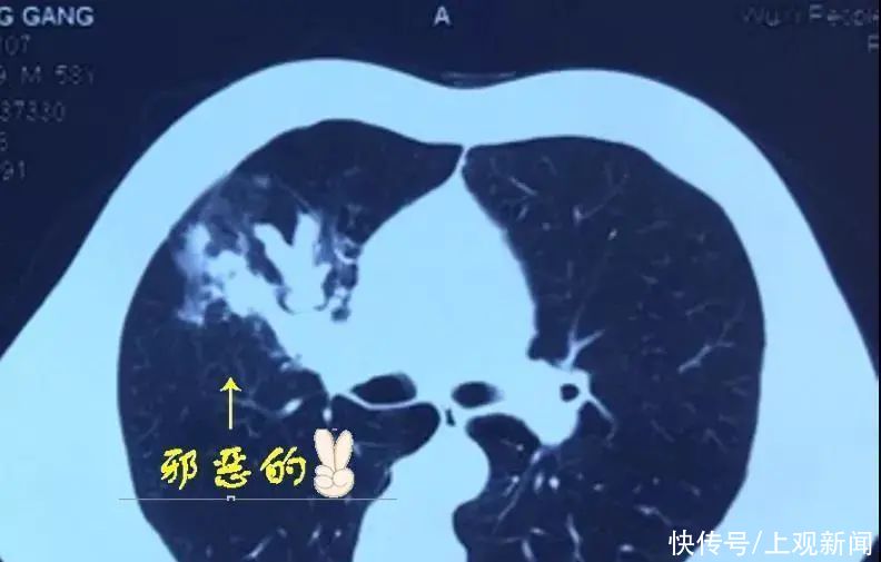 支气管|神逆转！被诊断为“肺癌”差点去开刀，结果竟是……