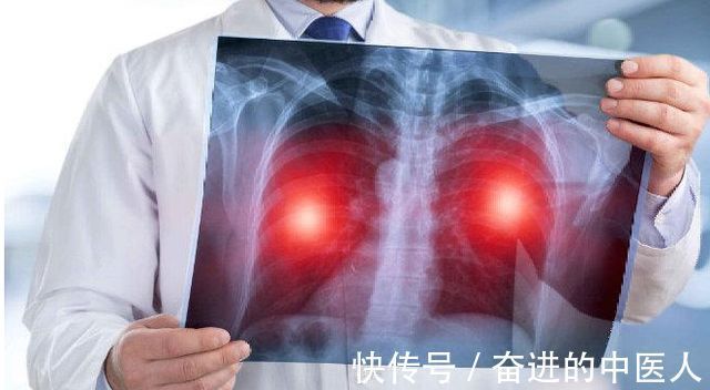 肺肿瘤|成都中医肿瘤医院:肺肿瘤病人能活多久?怎么改变这种局面