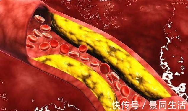 福音|高血脂人的“福音”被发现,身体出现4种“怪像”,建议查下血脂