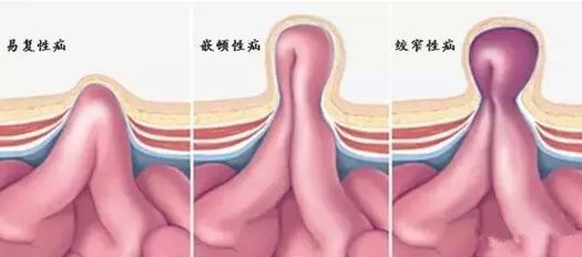 腹壁|德州市中医院外一科：“疝气”虽小，也能要命！