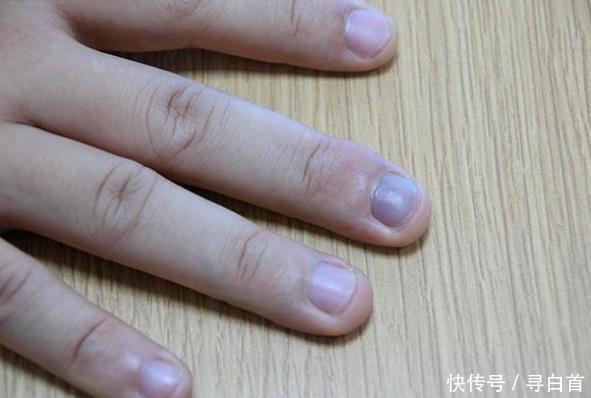 变化|指甲上没“月牙”就是身体不好指甲若没4种变化,说明身体不错