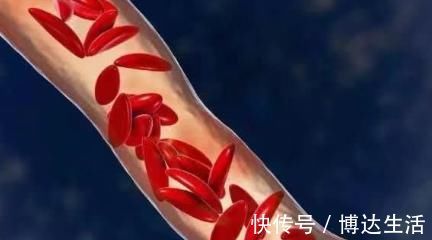 高脂血症|甘油三酯超标的人怎么办?几种食物要多吃,可软化血管净降血脂