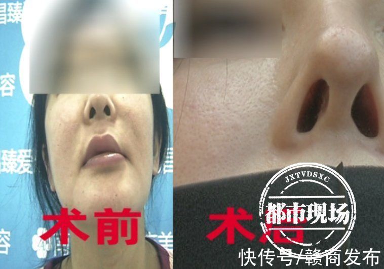 南昌 美女隆鼻整成“歪鼻女”南昌臻爱医疗美容遭投诉