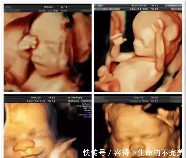 四维彩超|为什么我的四维彩超图像没有别人的清晰?