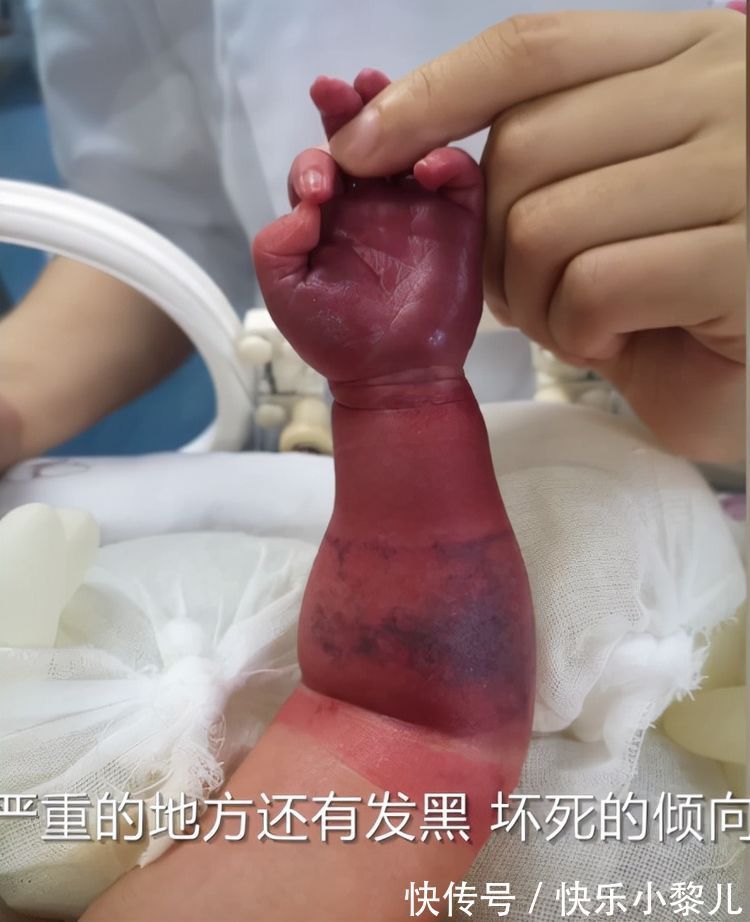 宝宝|无知还是粗心?新生儿仅出生一天险遭截肢,家长切记别犯这个错误