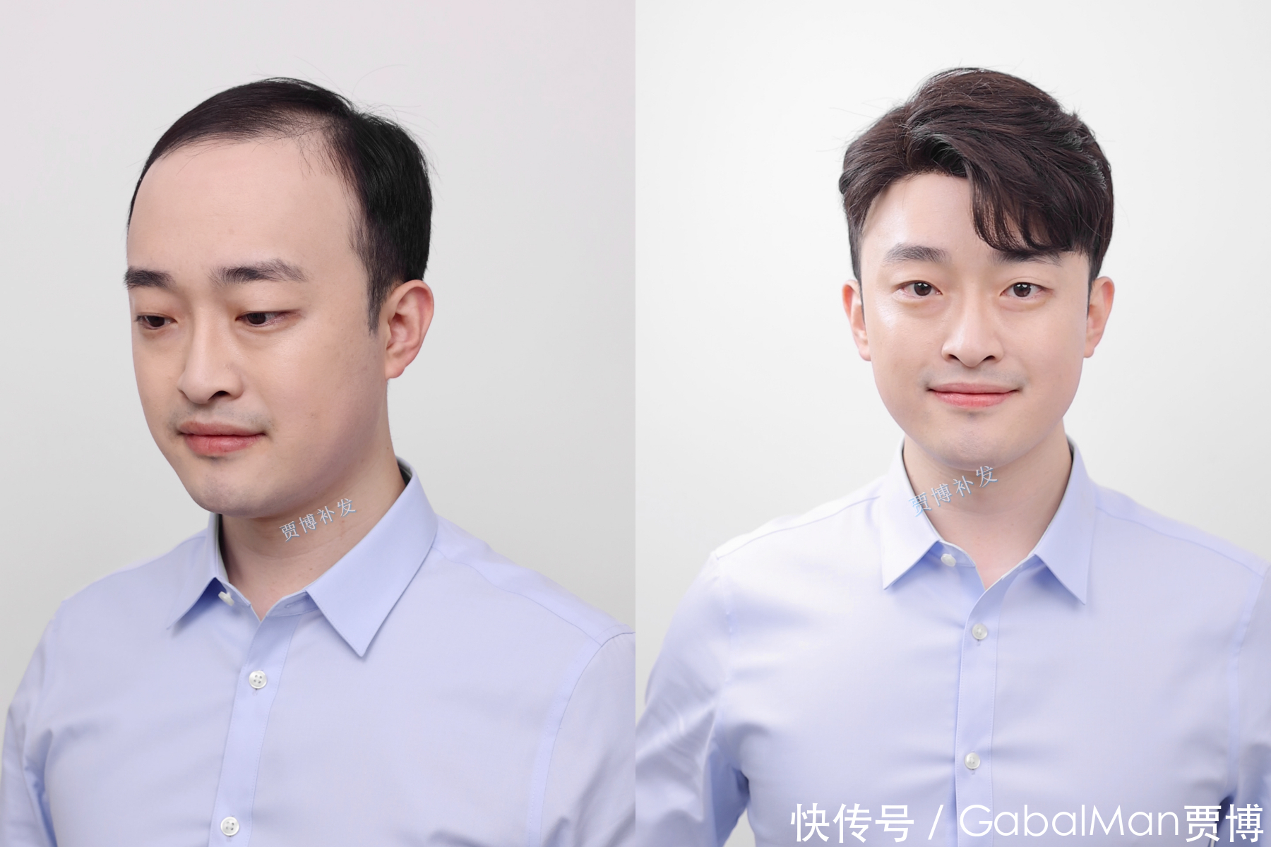 发际线脱发|60分钟拯救你的发际线!告别高额头,让你更显年轻