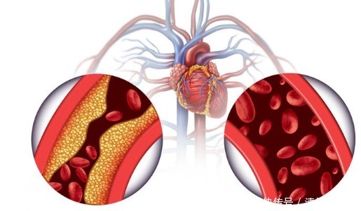 心血管医生提醒这些症状是血管堵塞、血栓预兆！这样才能预防
