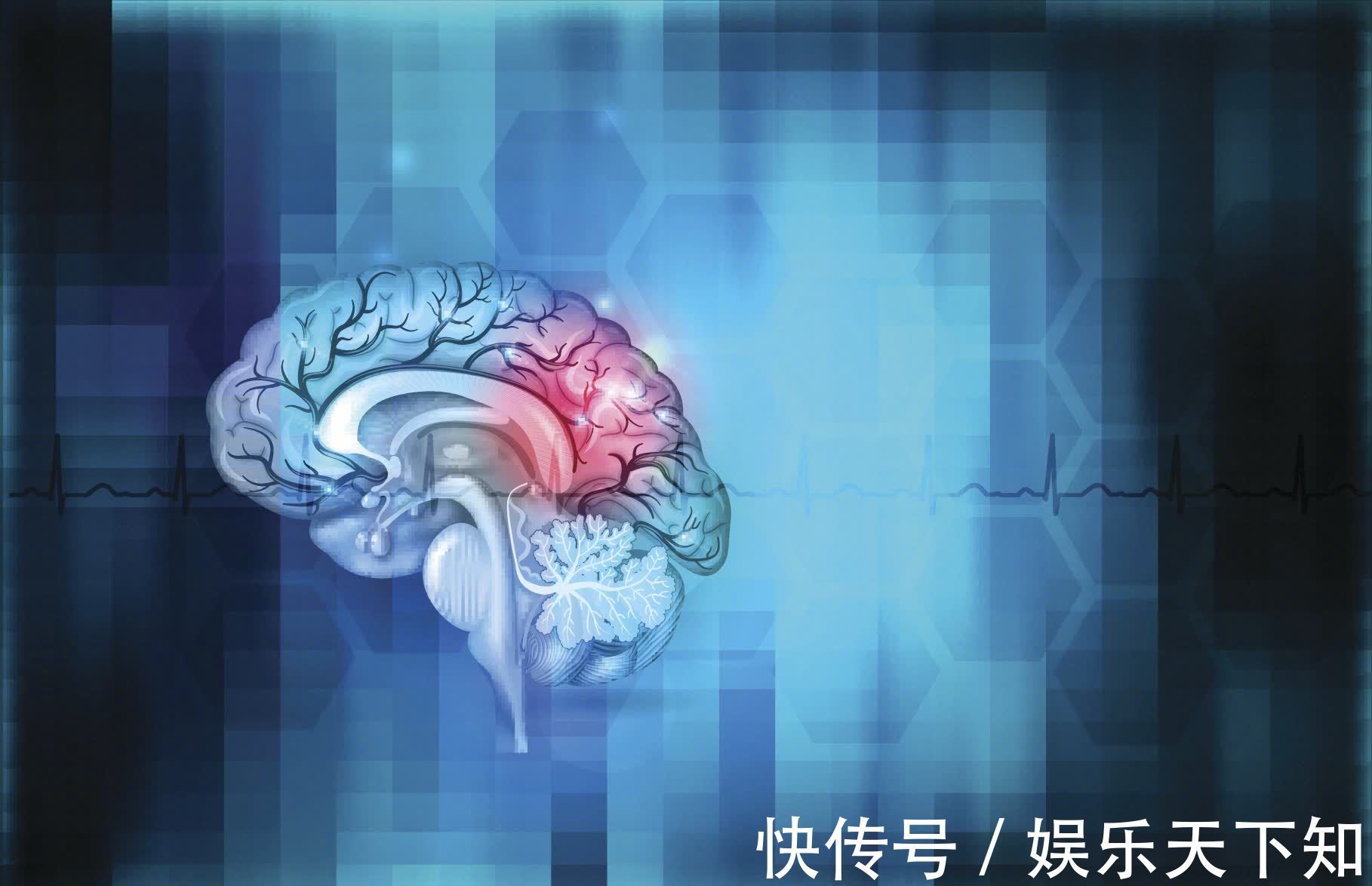 斑块|脑梗不到1年就复发，咋预防？饮食坚持3远2近，脑梗越来越远