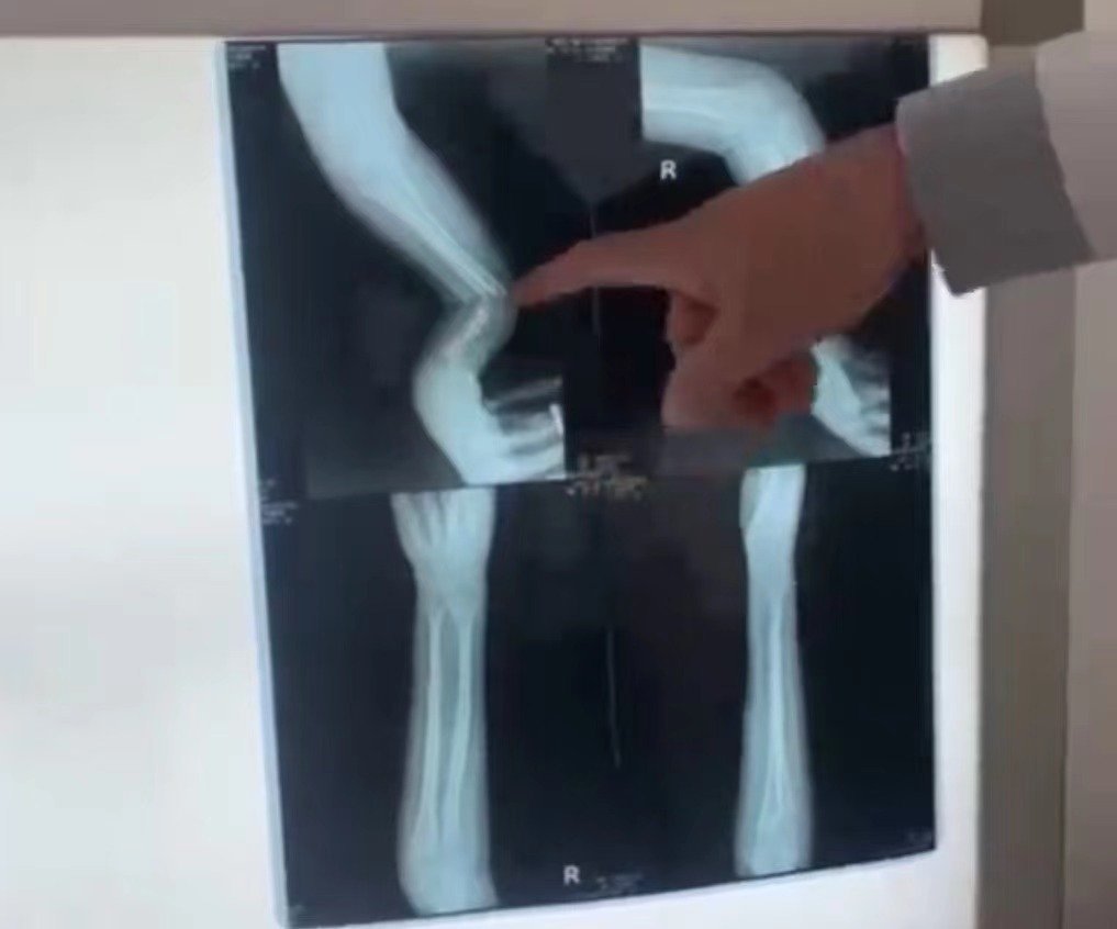 手臂|7岁男孩手臂摔成7字型,怕家长责罚耽误1小时才告知,差点成残疾