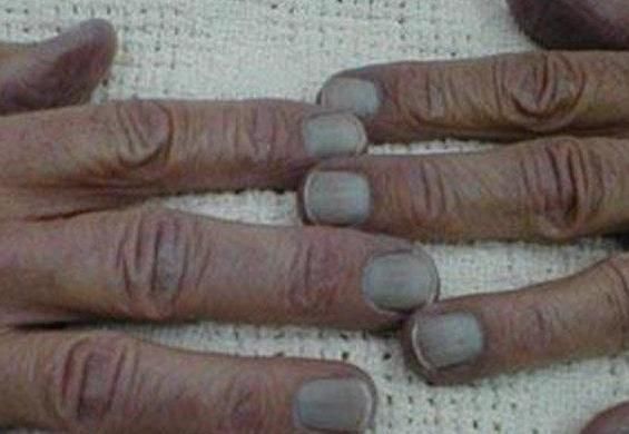 检查|指甲如果长成5种样子,说明你的身体状况不是太好,需要检查了