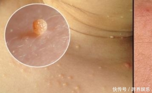 激素水平|脖子上的“小肉疙瘩”是什么？可能与3个原因有关