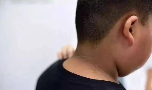 铁皮石斛|有没糖尿病,看看脖子就知道,常吃5物,血糖轻松降下来