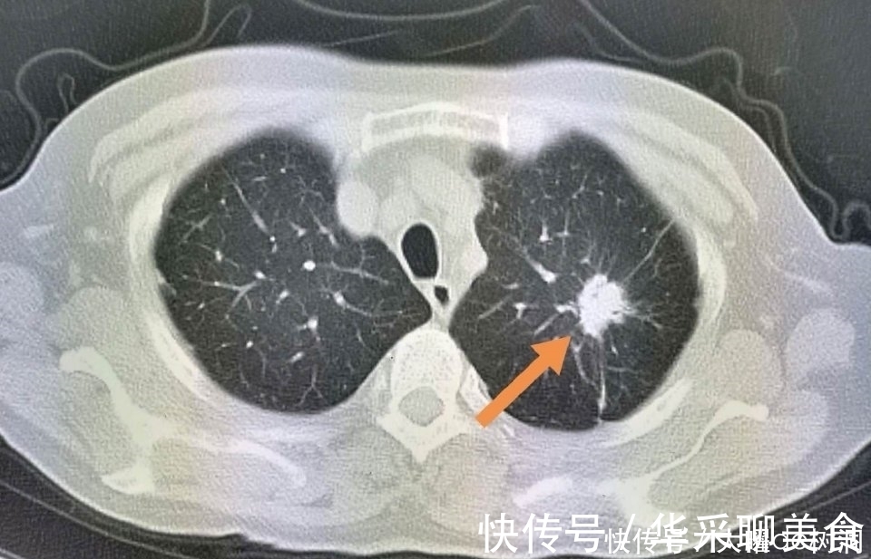 体检|年年体检,为什么还得了晚期肺癌?体检有啥用!