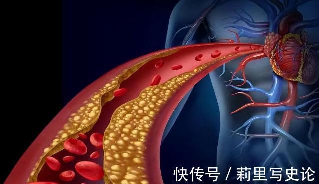 疫苗|“血脂疫苗”正式启用了,每年只需注射两次,什么人都可以打?